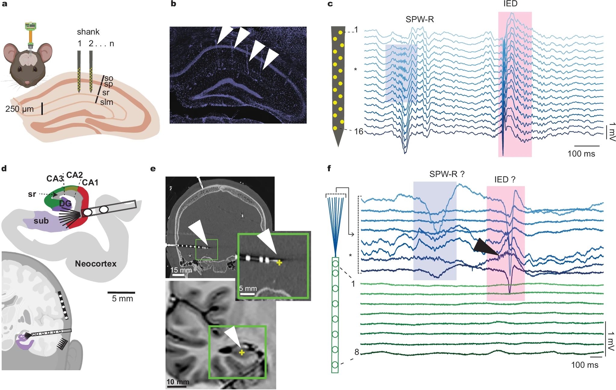 Clarifying Ripple Detection in Epilepsy Research